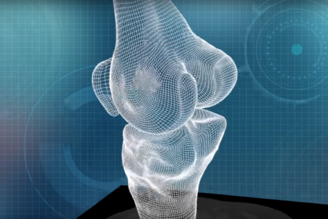 customised-knee-implants-comformis