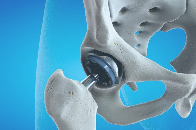 customised-hip-replacement-benefits-symbios
