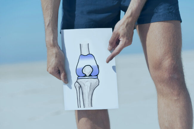 Man on beach holding a paper with a knee joint diagram