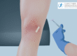 Knee with medic performing an arthrosamid injection for osteoarthritis