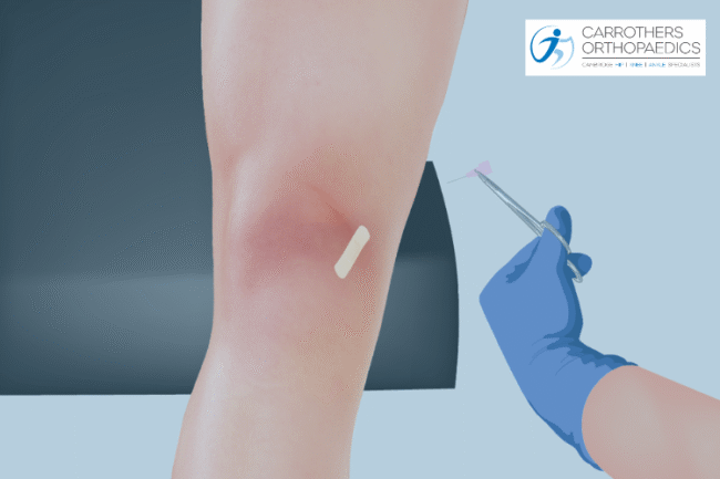 Knee with medic performing an arthrosamid injection for osteoarthritis